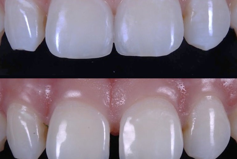 دکتر بستن فاصله بین دندان در شیراز