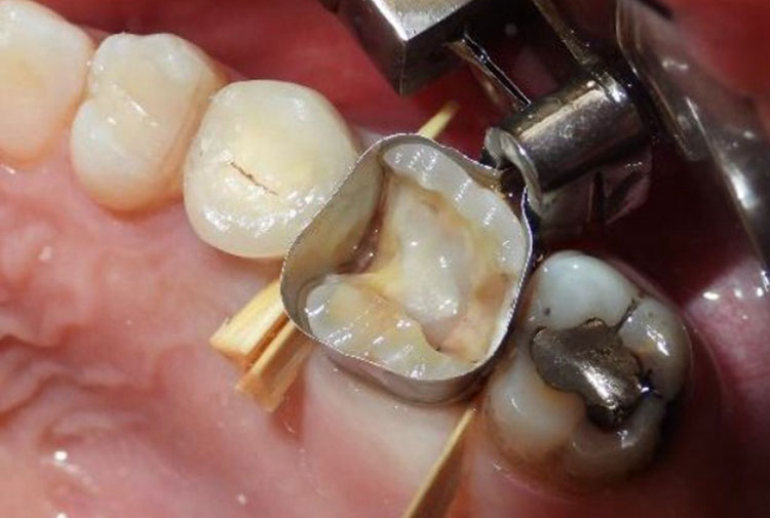 دکتر کف بندی دندان در تهران